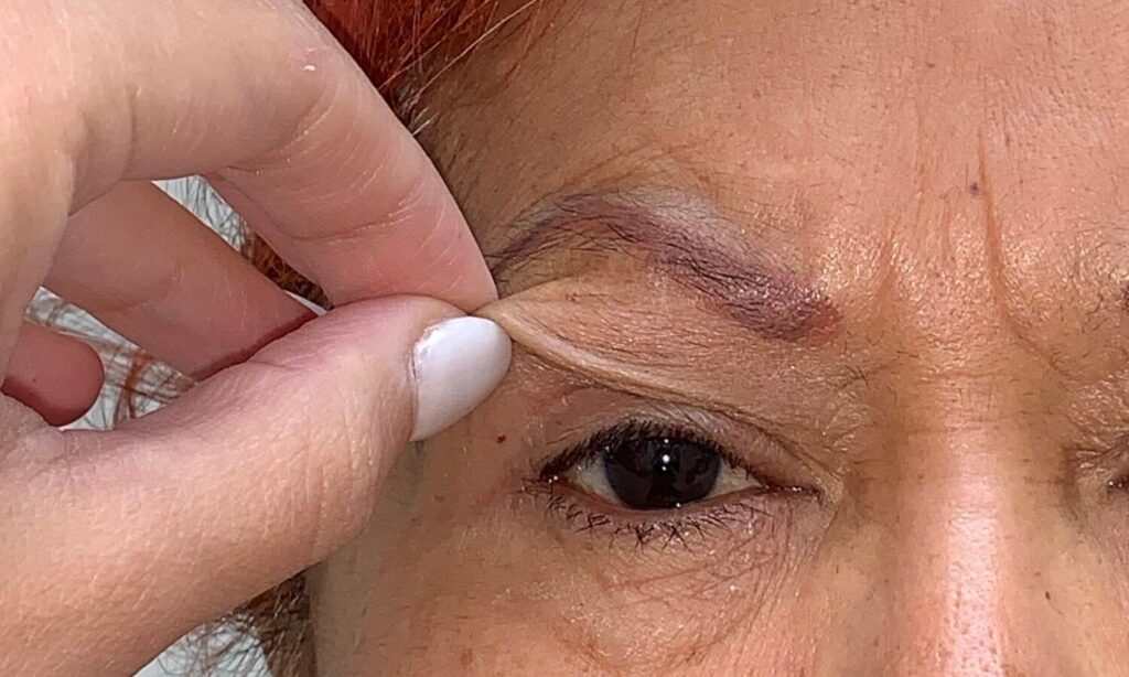 Rejuvenecimiento de ojos