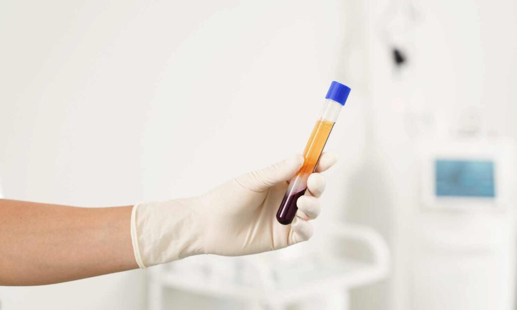 Plasma rico en plaquetas como rejuvenecimiento facial Ciudad Juarez