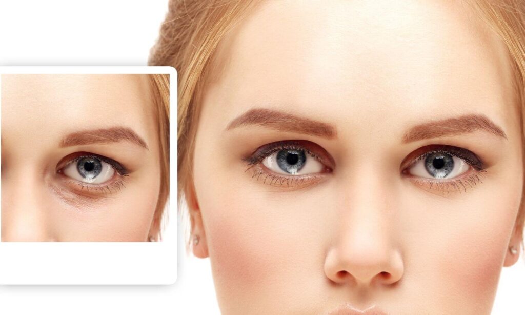 Blefaroplastia con laser CO₂