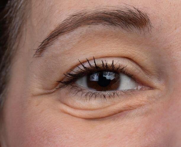 Blefaroplastia superior e inferior en Puerto Vallarta