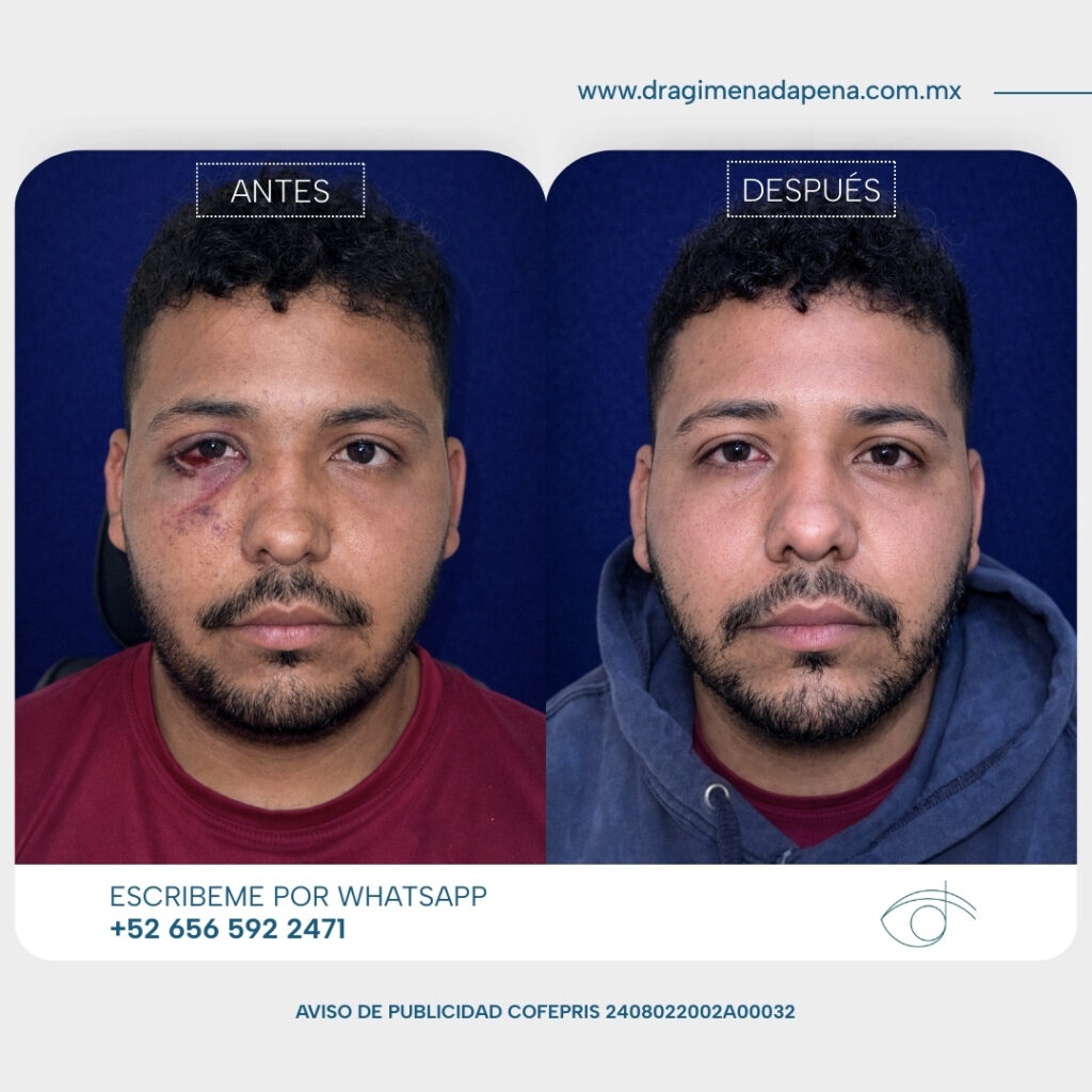 Caso 2 Paciente masculino reconstruccion de parpado inferior intubacion de via lagrimal