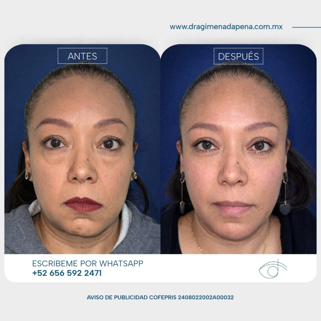 Caso Blefaroplastia superior e inferior transposicion de bolsas grasas inferiores