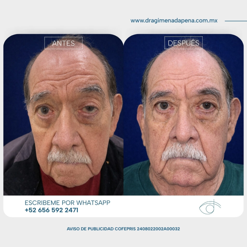 Cirugia de ptosis unilateral reintervencion