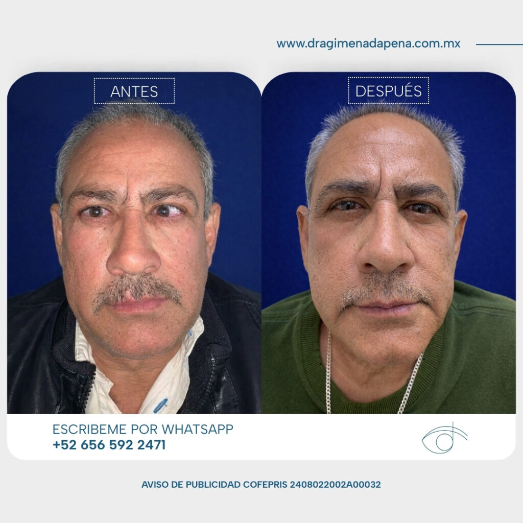 Tratamiento medico de orbitopatia tiroidea activa